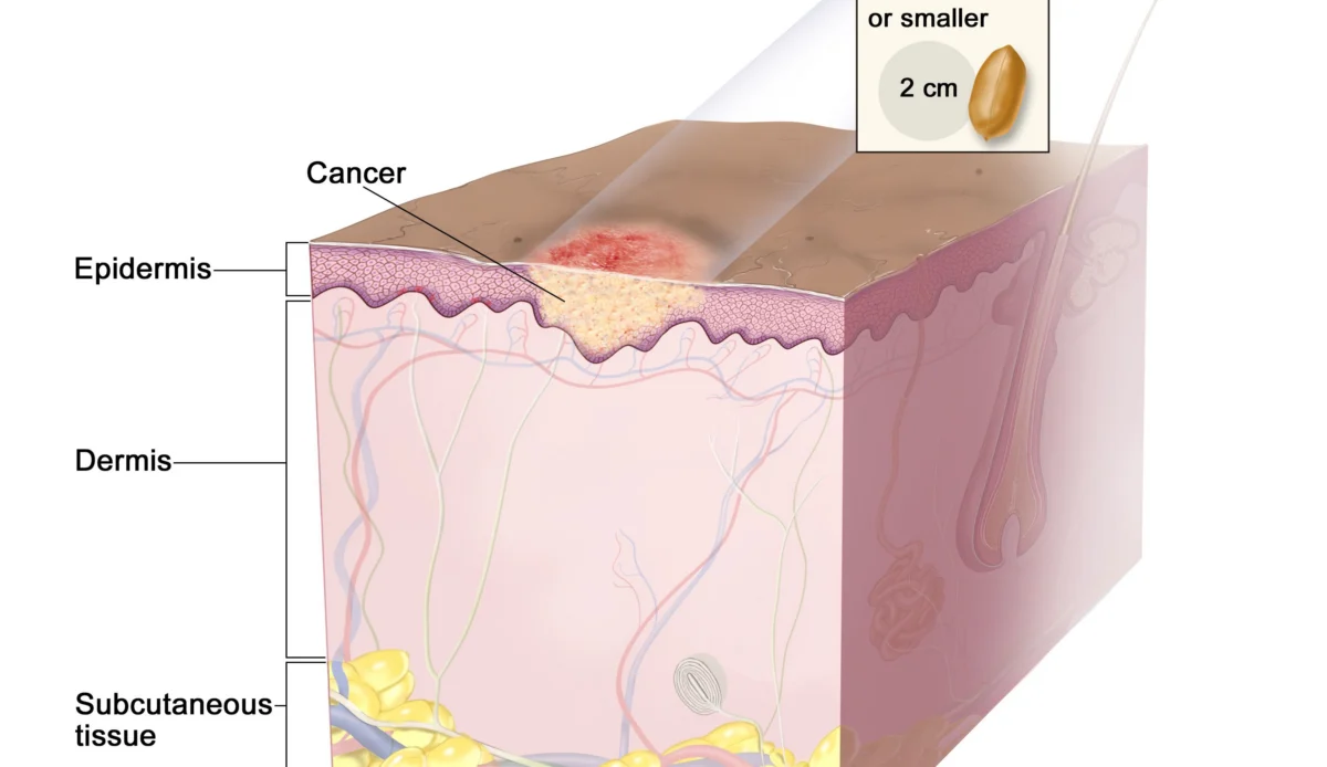 Skin Cancer Treatment (PDQ®)